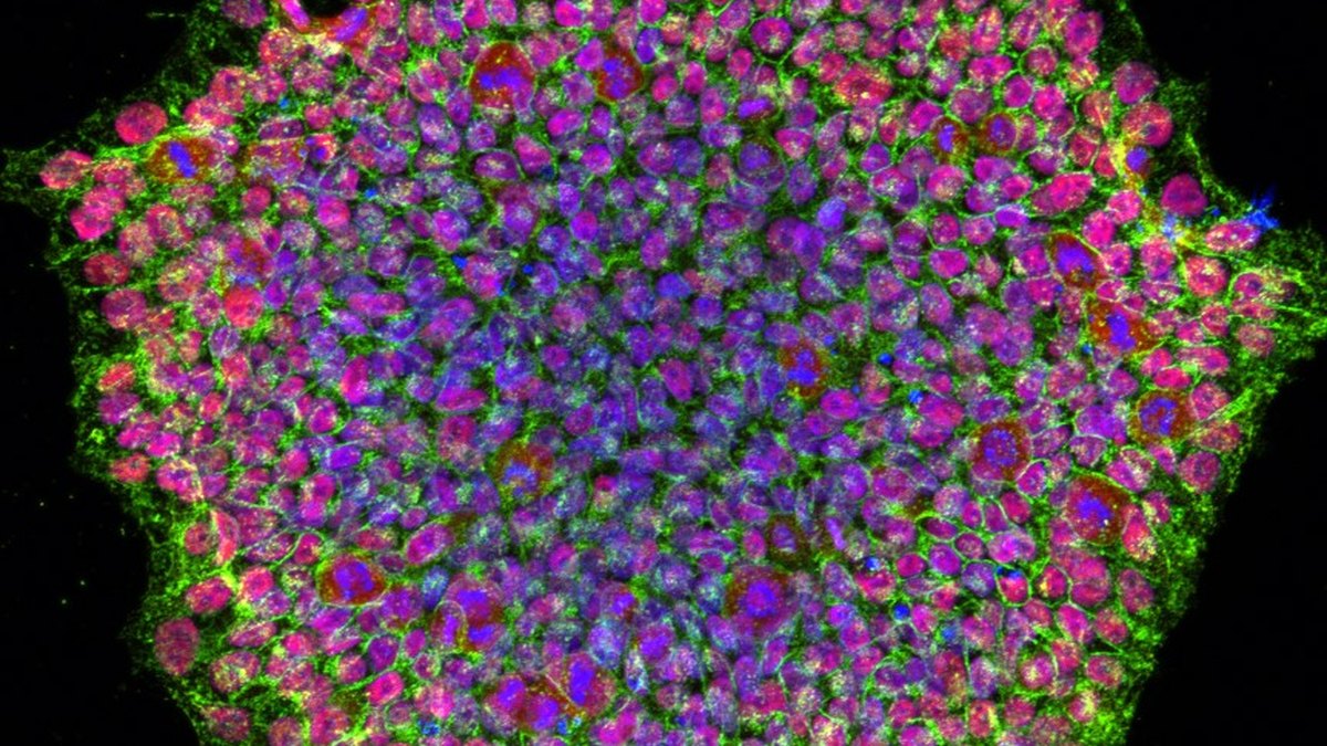 Immunofluorescence image of an induced pluripotent stem cell colony reprogrammed from urine-derived stem cells — Panacea Bio Chem, Bogdan Dicoias